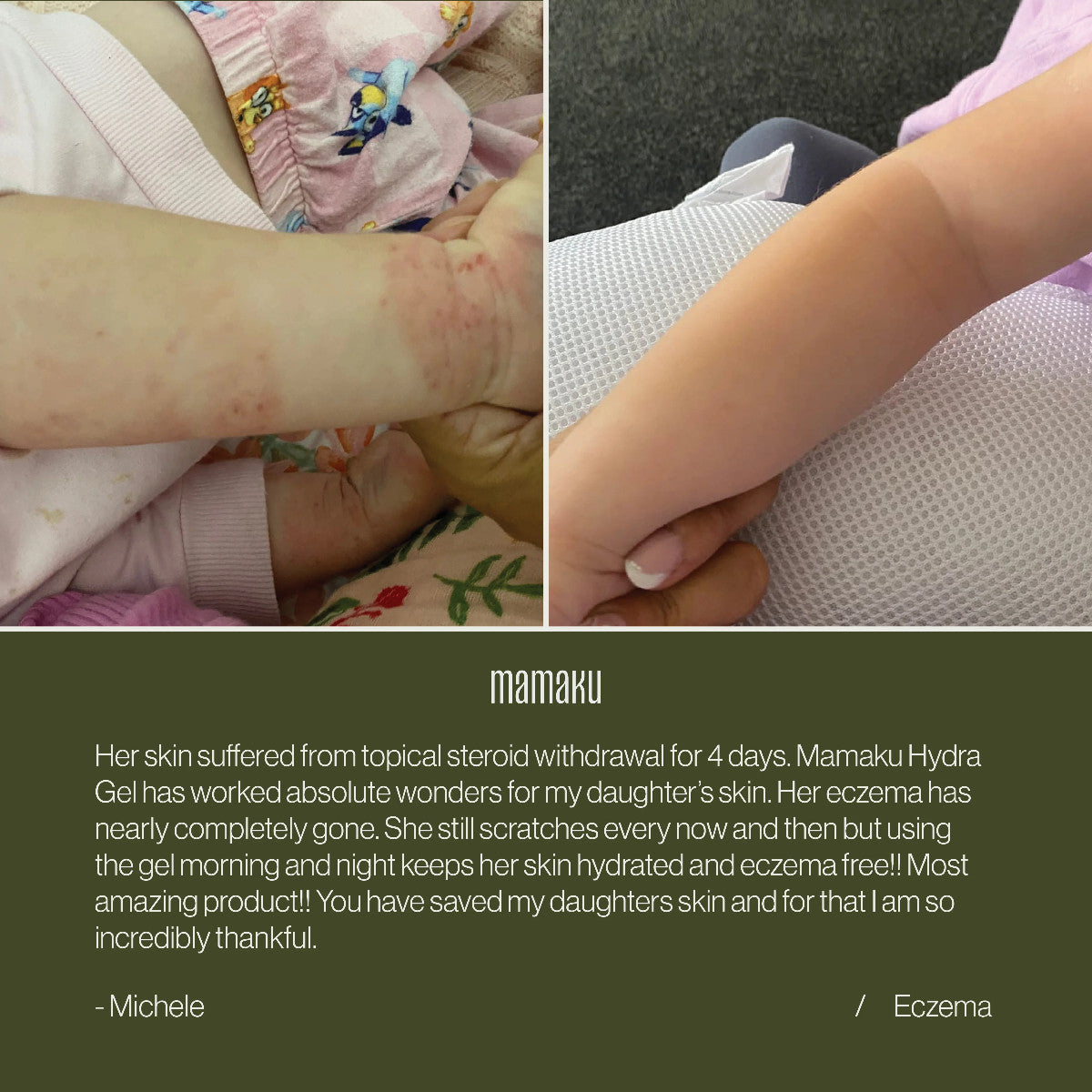 Review tile for Advanced Hydra Gel showing a before and after shot of Eczema before the gel and after. 