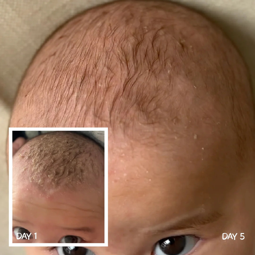 Cradle Cap Scalp Cream