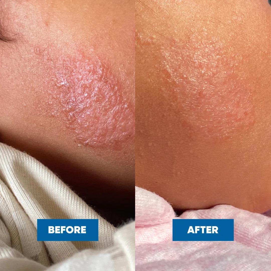 Eczema & Psoriasis Cream