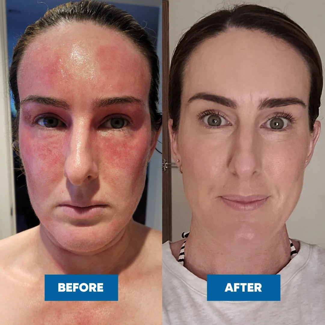 Eczema & Psoriasis Cream
